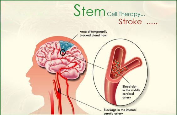 what would happen if the brain stem was damaged